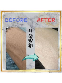フェリッセ(FELISSE)/Before & After (うで) 4回