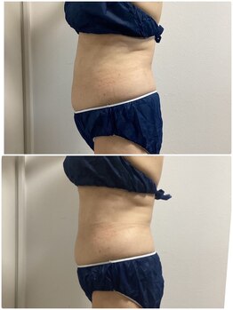 プリマプリート 可児店/脂肪冷却！通い放題途中経過！！