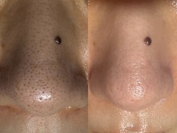 サラグランデ(Sara Grande)/毛穴エクストラクション