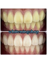 ホワイトニングショップ 津店/BeforeAfter