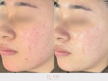 ルーミー 南青山(LUME)/乾燥/鎮静/かゆみ