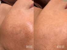 ウォーム(warm)/シミケア/美白/脱ピーリング