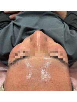 リリ(LiLi)/ビオフィート・ビフォーアフター