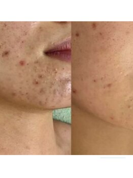 リラクゼーションサロンネロリ/ハーブピーリング &nbsp;有剥離