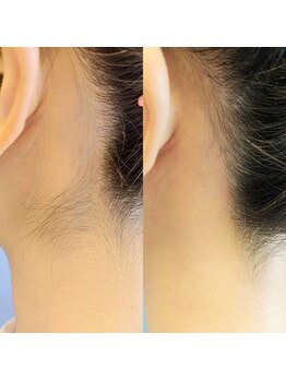 キアラ 麻布十番(Kiara)/うなじ脱毛のビフォーアフター