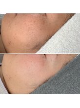 エステティックサロン S/毛穴の変化、トーンの変化