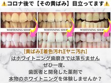 ホワイトニング歯磨きでは落ちません。正しいホワイトニングを！