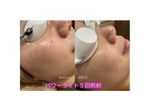 メディカルサロン フィオレ(fiore)/光パワーライトフェイシャル効果