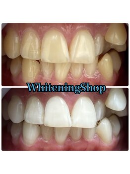 ホワイトニングショップ 津店/BeforeAfter