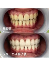 アイブロウ33/ホワイトニング　