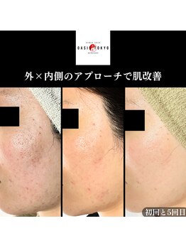 オアシス トウキョウ 川崎店(OASIS TOKYO)/幹細胞ハーブピーリング