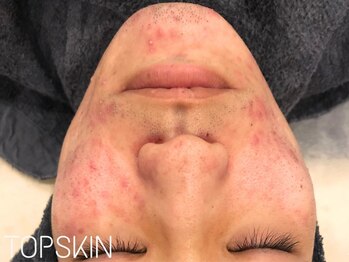 トップスキン 名駅(TOPSKIN)/30代メンズ/ハーブピーリング