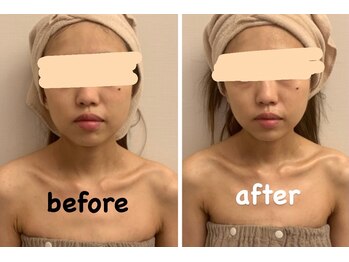 ララ(LALA)/【姪浜】小顔矯正/リフトアップ