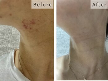 ホーミー(Homie)/長年のお肌悩み改善◎