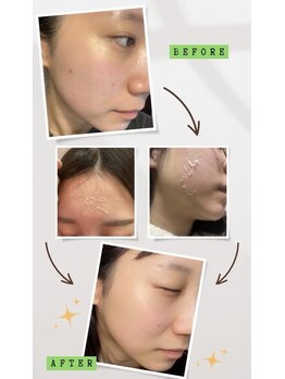 ノイ(noi.)/ハードタイプの皮剥け経過