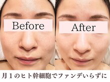 シエル(Siele)/ヒト幹細胞フェイシャル