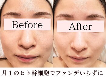 シエル(Siele)/ヒト幹細胞フェイシャル