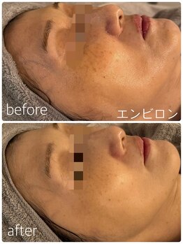 シャンス(Chance)/体験エンビロン♪ 症例1回目