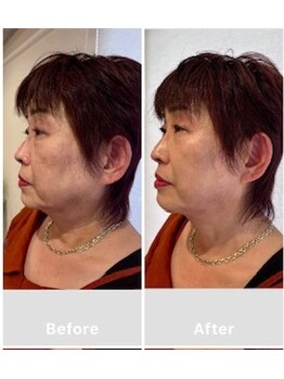 鍼日和/【鬼美容鍼】＋【ヘッドスパ】