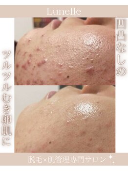 ルネル(Lunelle)/凹凸肌をむき卵肌に