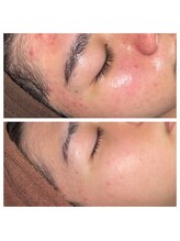 プルメリア(Plumeria)/スヴェイルスキンニキビ効果3