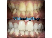 ホワイトニングショップ 津店/BeforeAfter