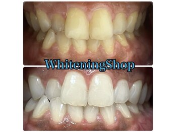 ホワイトニングショップ 津店/BeforeAfter