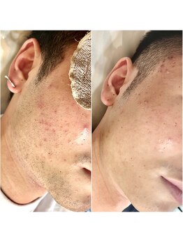 シシエル(CHICIEL)の写真/【青ヒゲと肌荒れをなくしたい方へ】剃る・荒れる・また剃るを繰り返さないためのヒゲ脱毛/ヒゲ脱毛