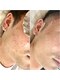 シシエル(CHICIEL)の写真/【青ヒゲと肌荒れをなくしたい方へ】剃る・荒れる・また剃るを繰り返さないためのヒゲ脱毛/ヒゲ脱毛