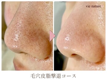 ヴィナチュール(vie nature)/毛穴皮脂撃退コース