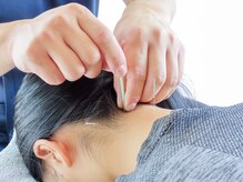Drハリー 新宿/【肩こり・頭痛】鍼施術
