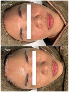 セローナ(Selona)/シワが気になる方へ