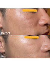 アプローズ(APPLAUSE)/メンズお肌メンテ