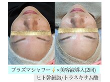 アースコアフュールボーテ ひたち野うしく店(EARTH coiffure beaute)/プラズマシャワー 毛穴ケア