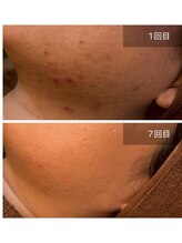 ビビ(VIVI)/フェイスラインのニキビに