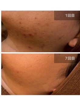 ビビ(VIVI)/フェイスラインのニキビに