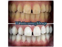 ホワイトニングショップ 津店/BeforeAfter