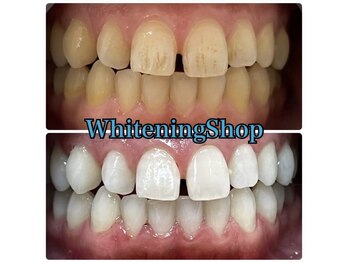 ホワイトニングショップ 津店/BeforeAfter