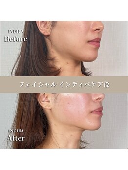 術後の女神 大阪本町店/ダウンタイムケア・インディバ