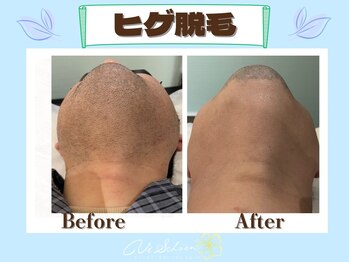 ヴィ シェーン(Vi Schoen)/【ヒゲ脱毛】Before/After