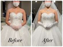 ビジョーラ 銀座本店(BEJORA)/1,ハイパーナイフ10回施術