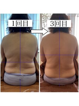 ナチュール(Nature)/腰、背中ビフォーアフター