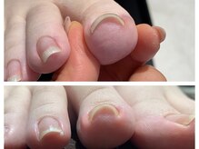 ウノプリール 梅田HARBIS PLAZA(uno pulir)/【巻き爪ケア】