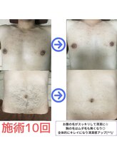 ラシンドウ 横浜鶴見店(RASHINDO)/【メンズ脱毛】胸＆お腹脱毛効果