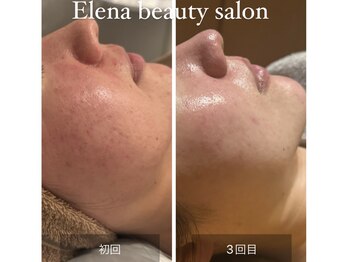 エレナ(Elena)/陶肌肌トリートメント