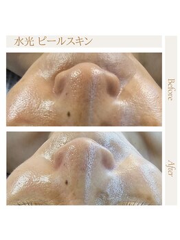 水光ピールスキン/水光ピール＋経絡ケアで