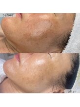 ストーミー(STORMI)/シミ改善 before → after