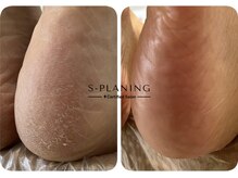 ロンディネ(Rondine)/足裏角質ケア