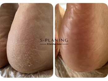 ロンディネ(Rondine)/足裏角質ケア