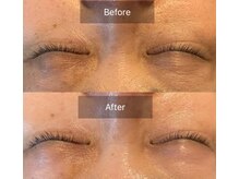 テセラ(TETHERA)/ナノテクノロジーフェイシャル